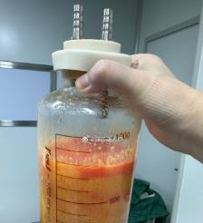 祁阳水动力吸脂手术要做多久？